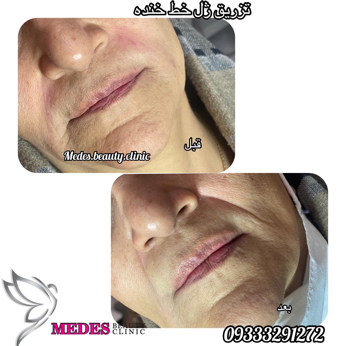 تزریق ژل خط خنده